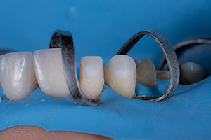 Teeth Nos. 6 and 7 isolated with accessory clamps in preparation for veneer insert.