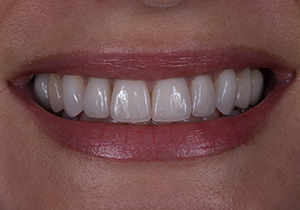 Full smile, postoperative. Patient was exceedingly pleased with her rejuvenated smile and the esthetic outcome achieved with 10 maxillary lithium-disilicate porcelain veneer restorations.