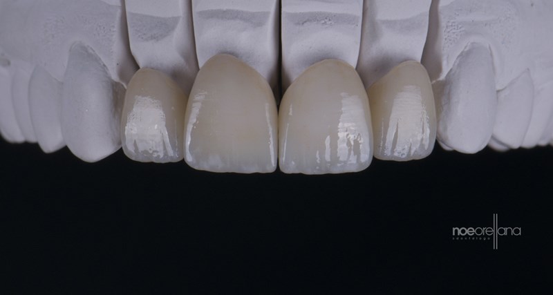 Lithium disilicate restorations with surface stain technique