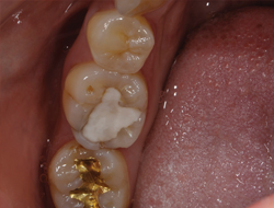 figure 1 existing composite was removed