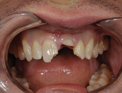 figure 4 patient with fractured No. 9 at the gingiva