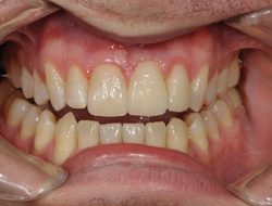 figure 6 IPS e.max porcelain veneers were seated on tooth Nos. 8 and 10