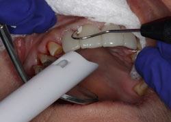 figure 7 delivery of front crowns