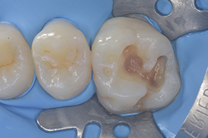step 2 isolation and caries removal