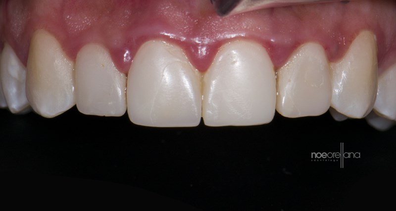 Gingival inflammation