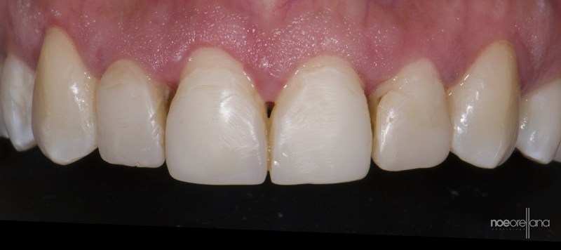 Healthy Gingival Tissue
