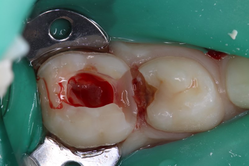 pre-operative view primary second molar