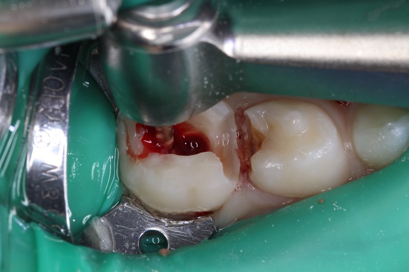 primary second molar requiring pulpotomy procedure