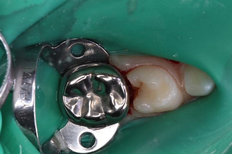 patient’s full-coverage stainless-steel crown