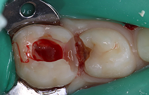 pre-operative primary second molar requiring pulpotomy procedure