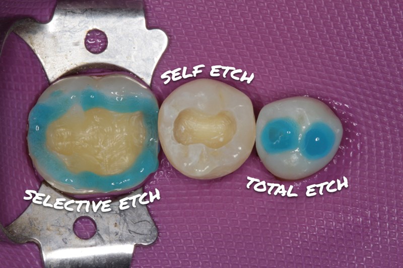 dental etching techniques