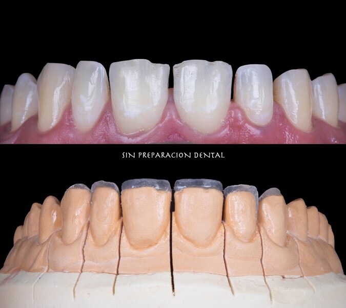 No prep veneers preparation