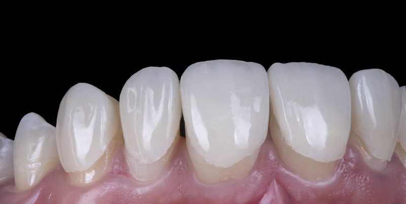 No prep veneers try in