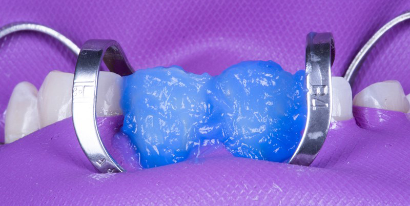 No prep veneers etch