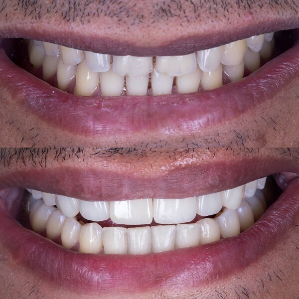 No prep veneers pre op post op no prep veneer comparison