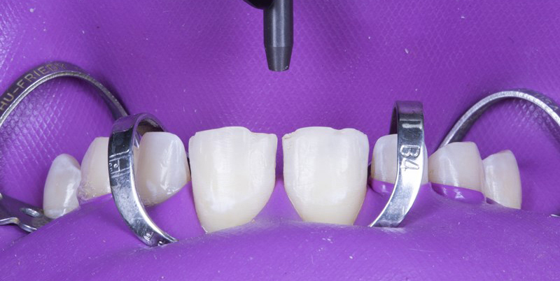 No prep veneers sandblast