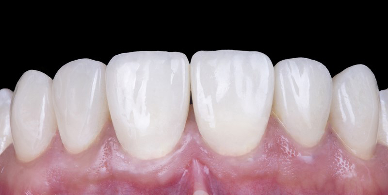 No prep veneers final restoration