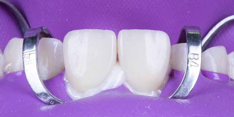 No prep veneers restoration